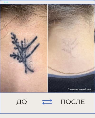 Удаление татуировки
